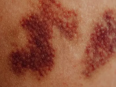 마사지 받고 멍이 들었다면 — 정상 반응과 병…